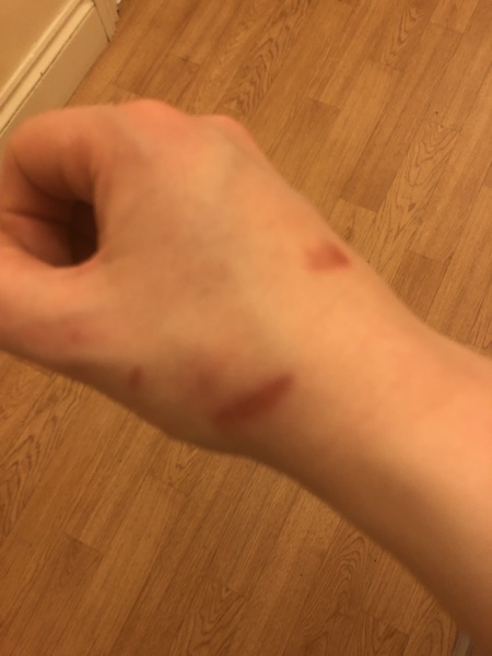 Will anything take the redness out of burns?!