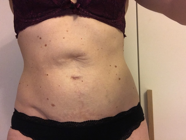 Diastasis recti and hernia surgery