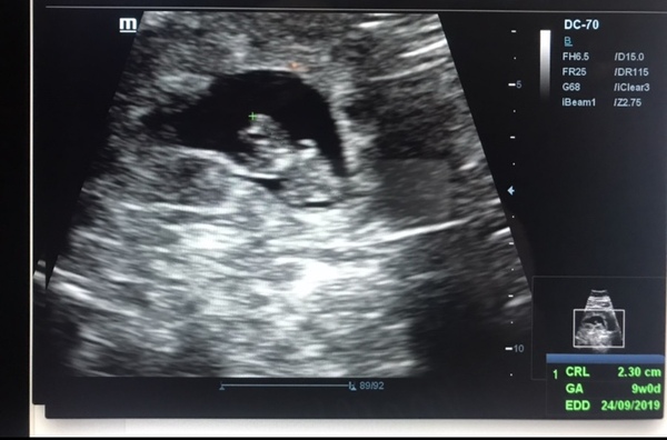9 week scan guesses?