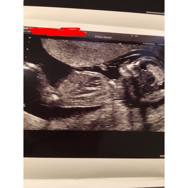 12wk scan gender guesses