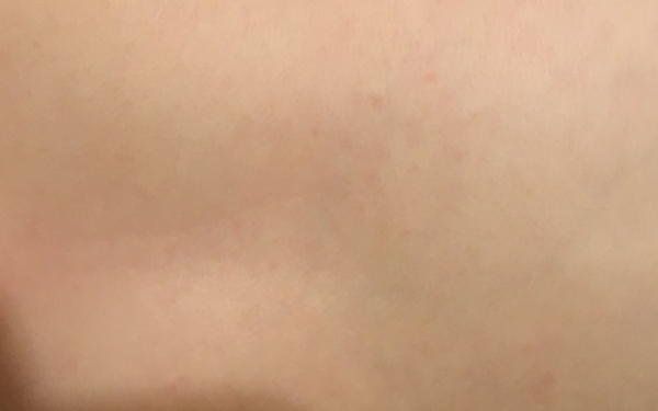 Help -spots on baby