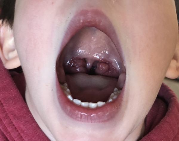 My tonsils