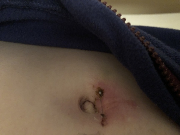 Post appendix nightmare - anyone got any advice