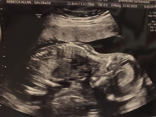 July 2019 (thread 8): pram choices, 20-week scans, and the morning gag