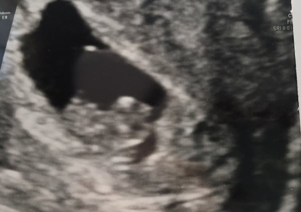 Paying for 8 weeks scan