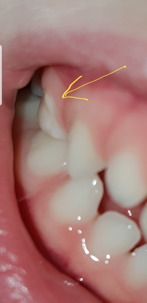 Toddler Tooth Decay/Plaque?