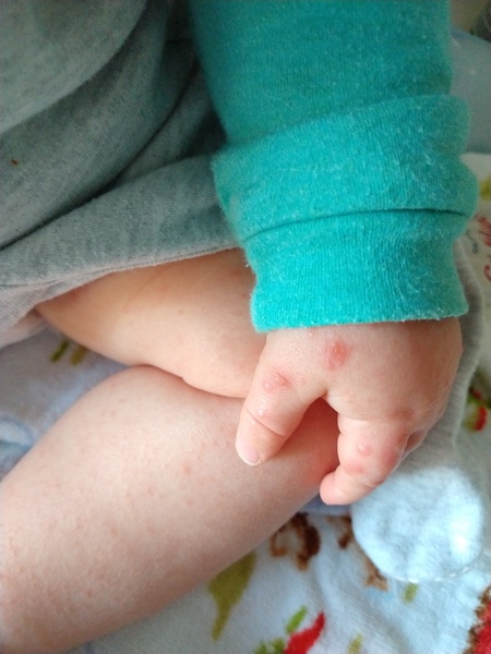 To ask how to know between chickenpox and hand foot and mouth