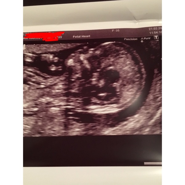12wk scan gender guesses