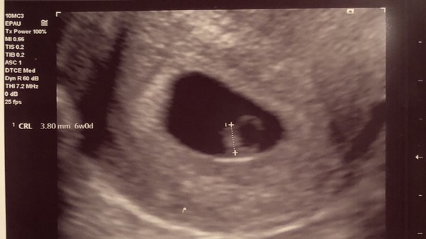 6 week scan