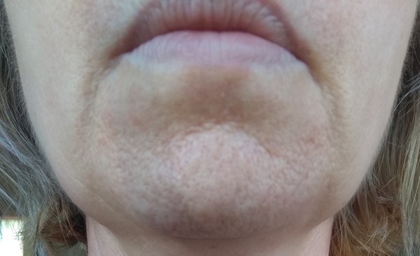 Skin Advice Please 😪