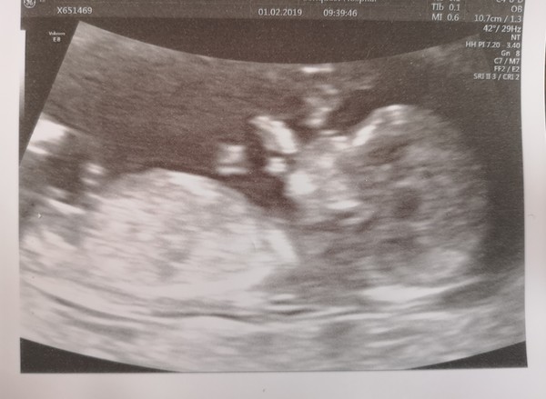 August 2019 4: All the scans and hopefully the end of nausea