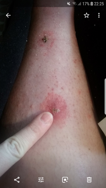 Post appendix nightmare - anyone got any advice