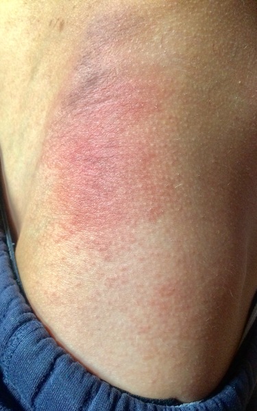 Help needed with son’s rash, any ideas?