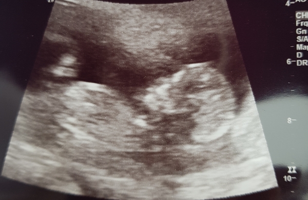 Boy or girl