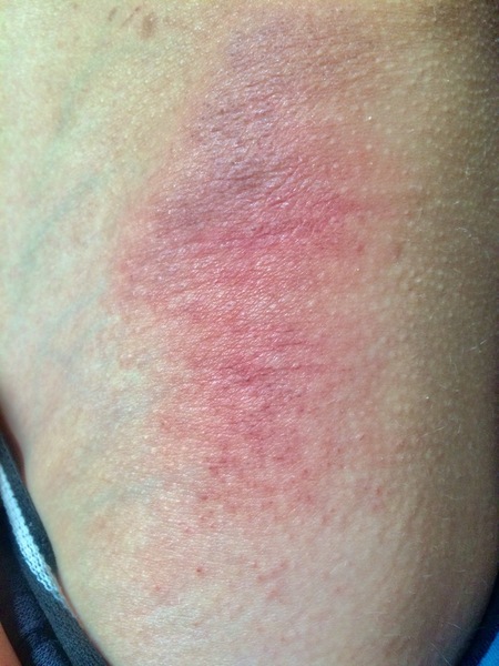Help needed with son’s rash, any ideas?