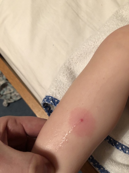 WTF has bitten my son? Tick?