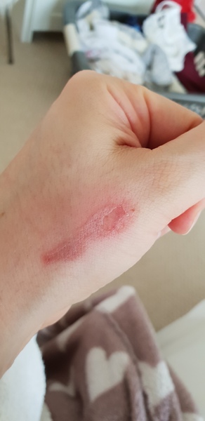 Burn on hand how to treat