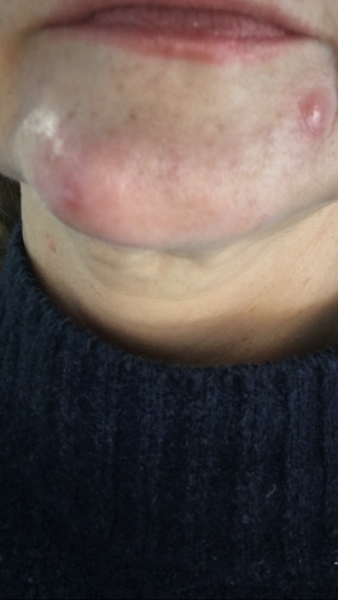Big Pesky Spots!