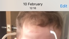 Help! Scar on my LO's face