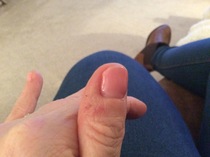 Terribly dry cuticles and skin around nails