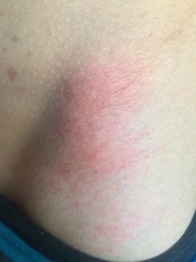 Help needed with son’s rash, any ideas?
