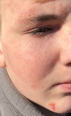 Help please! Cannot get skin condition under control (pics)