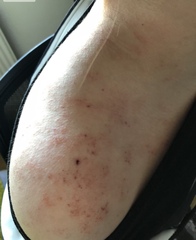 Help please! Cannot get skin condition under control (pics)