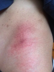 Help needed with son’s rash, any ideas?