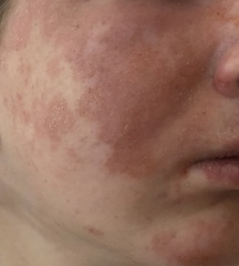 Help please! Cannot get skin condition under control (pics)