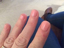 Terribly dry cuticles and skin around nails
