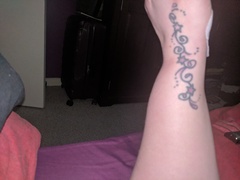 Carpol tunnel 5 day's post op