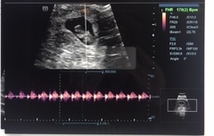 9 week scan guesses?