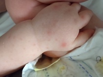 Chicken pox or hand foot and mouth??