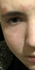 Help please! Cannot get skin condition under control (pics)