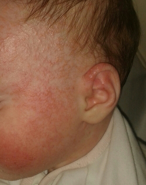 Methotrexate for Eczema
