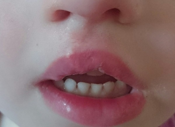 So upset about scar on DS