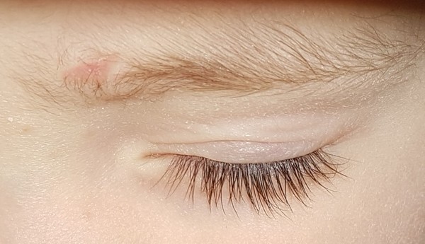 So upset about scar on DS