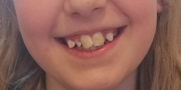 What was your dcs teeth like before braces? (NHS)