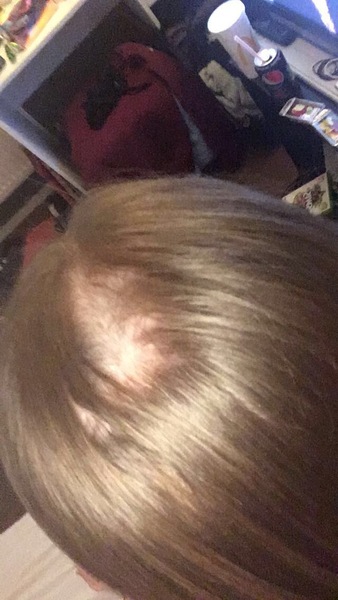 Sudden hair loss