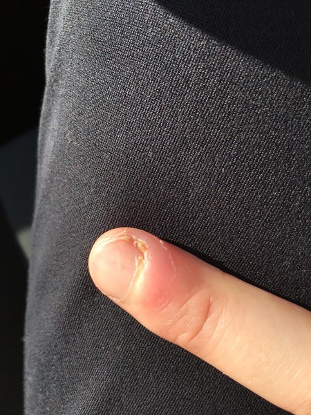 Infected finger for two weeks- advise me?