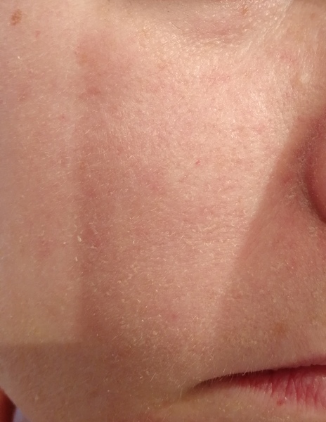I need a skin reset (or something)