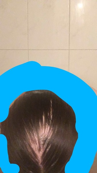 Sudden hair loss
