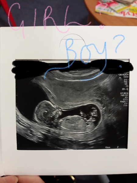 Girl or boy? 13&5 clear scan!