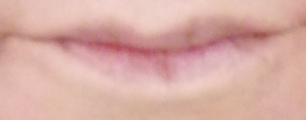 Should I get my lips filled?