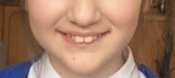 What was your dcs teeth like before braces? (NHS)