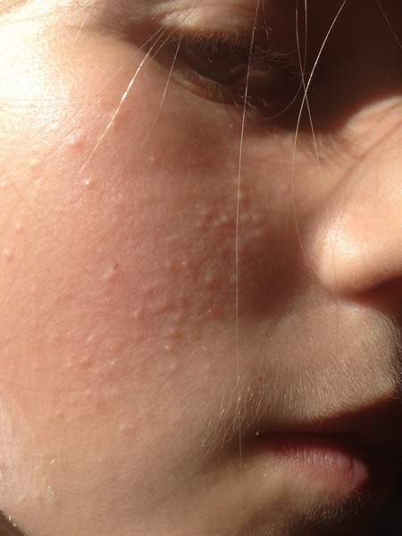 My six year old daughter has teenage skin :(
