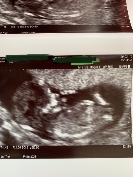 13 week scan, boy or girl?