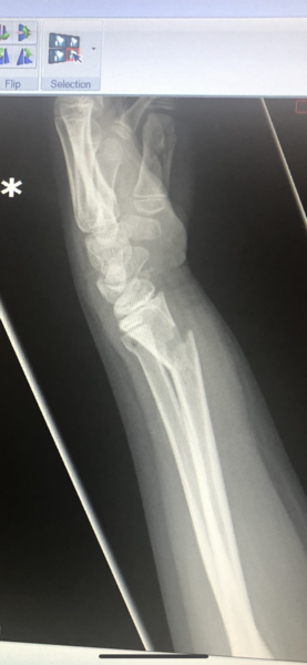 AIBU - Cast off after 15 days includes X-ray pic