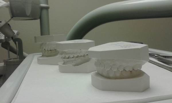 What was your dcs teeth like before braces? (NHS)