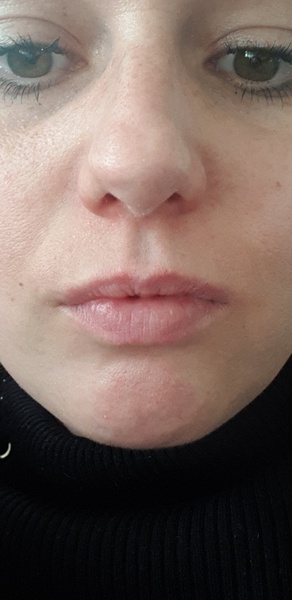 Should I get my lips filled?